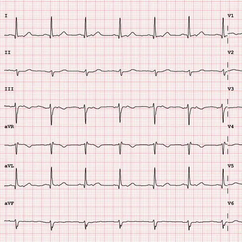 12 lead ekg