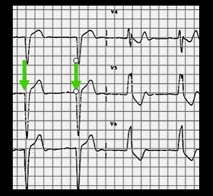 12-Lead EKG: From Start to Competent!