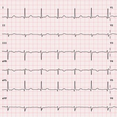 12 lead ekg