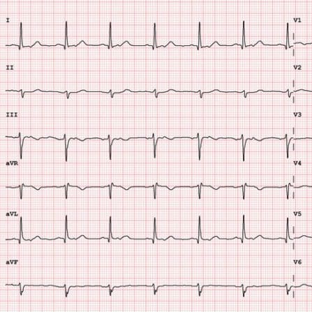 12 lead ekg