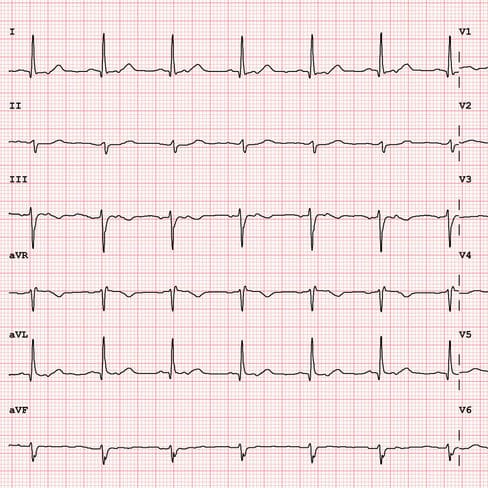 12 lead ekg