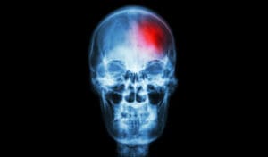 Nervous System Disorders