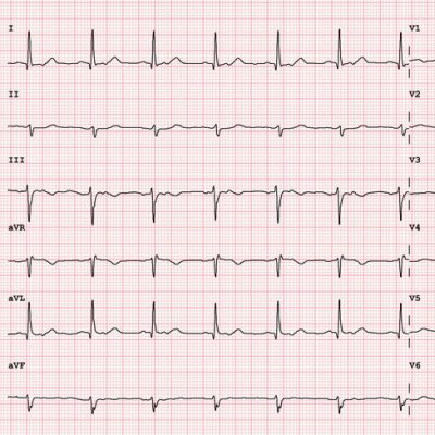 12 lead ekg