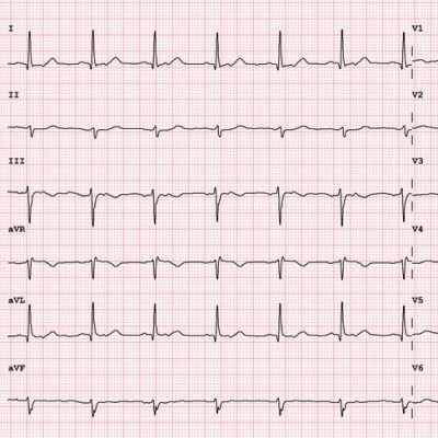 12 lead ekg