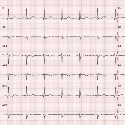 12 lead ekg