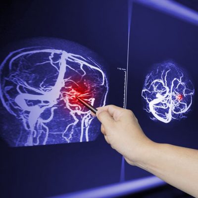 Close,Up,Hand,Doctor,Point,Mra,Brian,Scan,Image,Of