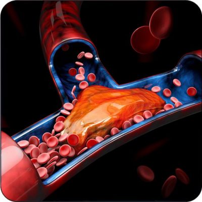 Venothrombic-Events