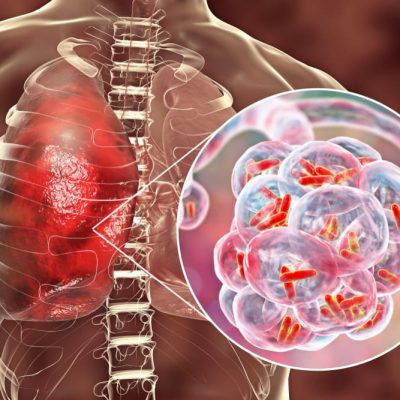 Drugs for Bacterial Infections